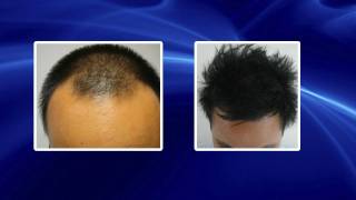 Haartransplantation mittels FUE Technik [upl. by Yacano]