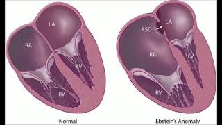 Ebsteins Anomaly [upl. by Ttimme78]