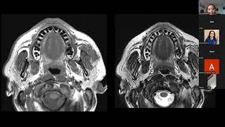 Radiological anatomy of Salivary glands  Dr Vasundhara Patil [upl. by Norehc]