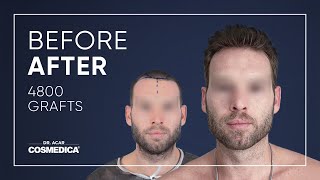 Hair Transplant in Turkey  Hair Transplant Results of Cosmedica [upl. by Esylla422]