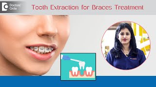 Tooth Extraction for Braces TreatmentExtractions in OrthodonticsDrNikhar RavinderDoctors Circle [upl. by Catharina]