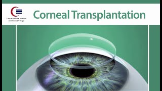 Corneal Transplantation by Dr Tanveer Chaudhry [upl. by Sachsse]