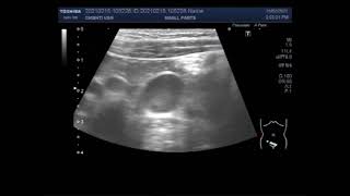 Mesenteric lymphadenitis [upl. by Thomas]