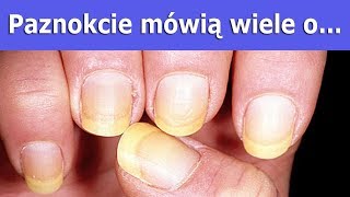 Paznokcie mówią wiele o twoim zdrowiu [upl. by Ruddy756]