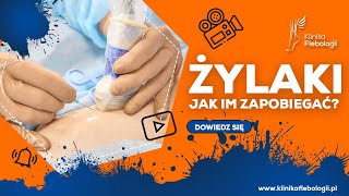 ŻYLAKI  jak im zapobiegać [upl. by Benkley]