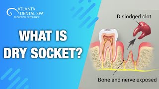 What is Dry Socket Top dentist says how to Prevent It  Atlanta Dental Spa 2019 [upl. by Kos]