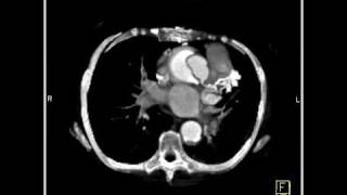 MDCT 64 Type A Aorta Dissection 2 of 2 [upl. by Aihsein]