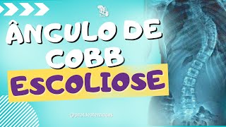 COMO MEDIR O ÂNGULO DE COBB  escoliose cobb [upl. by Goat]