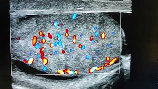 acute epididymoorchitis Tauhid ultrasonography Cumilla [upl. by Irehc]