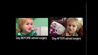 How does adenoid surgery effect a childs voice [upl. by Jasmina778]