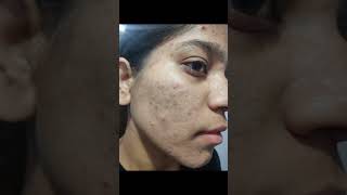 2 month complete tretinoin cream 0025 face tretinoin skincare tretinoincream darkspots face [upl. by Valle13]