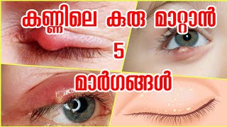 കണ്ണിലെ കുരു മാറ്റാൻ 5 മാർഗ്ഗങ്ങൾ  get rid eye stye  kankuru  കൺകുരു [upl. by Nylarat122]