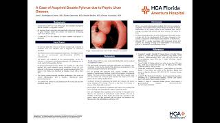 A Case of Acquired Double Pylorus due to Peptic Ulcer Disease [upl. by Atteuqcaj]