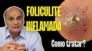 FOLICULITE INFLAMADA COMO TRATAR  SAIBA [upl. by Prady]