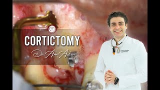 Corticotomy of impacted canine in orthodontics [upl. by Zzabahs]