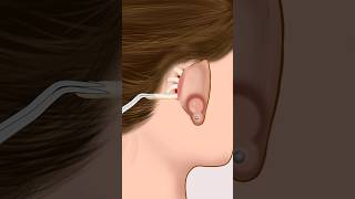 ASMR Infected ear piercing removal animation P1 animation asmr satisfying viral shorts [upl. by Lawrenson]