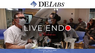 LiveEndo Upper Molar RCT [upl. by Elleniad]