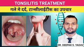 TONSILITIS CAUSES SINGS amp SYMPTOMS TREATMENT tonsillitis treatmentoftonsilitis [upl. by Ringo642]