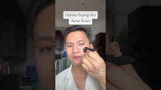 Derma Stamp for ACNE SCARS reels skincare acnetreatment acnejourney skincareroutine acnes [upl. by Eintihw]