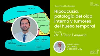 Hipoacusia patología del oído interno y tumores del hueso temporal por Dr Ulises Longoria Estrada [upl. by Acinomal]