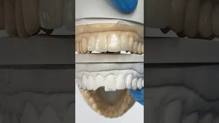 Working to replace a chipped tooth ​⁠EnvisiontecMain envisiontec lsk121shorts dentist teeth [upl. by Annayek766]