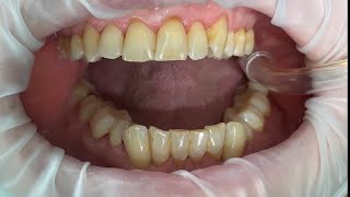 Dentistry  Scale Polish amp Tepe brushing ASMR [upl. by Ettenal]