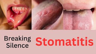 Breaking the Silence on Stomatitis  Understanding Stomatitis Causes Symptoms and Treatment [upl. by Ezitram464]