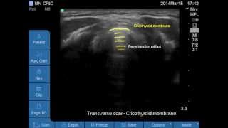 Ultrasound Airway anatomy Vocal cords Cricothyroid membrane Cricoid [upl. by Aerua]