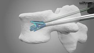 TripodFix Vertebral Augmentation System  Wiltrom [upl. by Suneya]