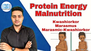 Protein Energy Malnutrition  Kwashiorkor Vs Marasmus [upl. by Locklin]