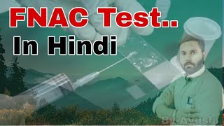 FNAC Test Results Normal Range Cost  यदि आपके शरीर में भी कोई गांठ है तो जरूर कराएं। [upl. by Amati]