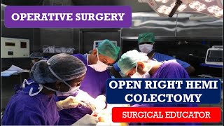 OPEN RIGHT HEMICOLECTOMY STEP BY STEP OPERATIVE SURGERY [upl. by Aseel]