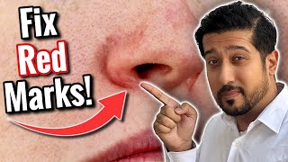 Redness Around Nose  Get Rid of Perioral Dermatitis FAST [upl. by Flodnar]