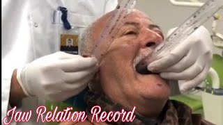 How to record Jaw Relation in Complete Denture  Clinical case [upl. by Josias404]