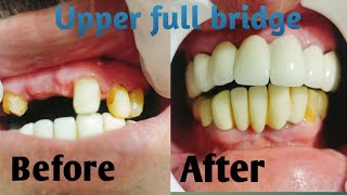 dental upper full bridge [upl. by Haff]