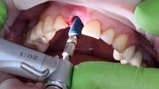 Stomatologie ChisinauBotanicaTerraDent Moldova Implant dentar imediat si coroana provizorie [upl. by Con]