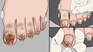 ASMR Ingrown Toenail Removal Treatment AnimationStrong Satisfaction  Mengs Stop Motion [upl. by Fiorenze]