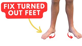 Fix TURNED OUT Feet with Two Easy Exercises duck feet [upl. by Meade]