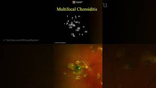 Multifocal Choroiditis Symptoms and Treatment ophthalmology optometry [upl. by Columbyne]