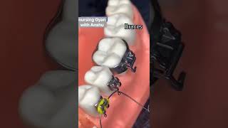 braces orthodontics braces orthodontist dental dentist shorts viralshorts [upl. by Ignatius]