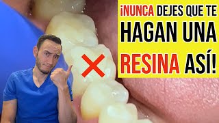 Nunca dejes que te hagan una resina dental así [upl. by Martguerita]