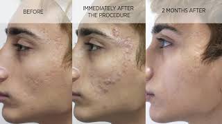 Acne scar subcision and filler [upl. by Germann]