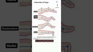 finger deformity swan neck mallet boutonniere shorts shortvideo anatomy medical [upl. by Macdougall]