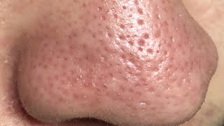 how to get rid of nose pores in 1 day [upl. by Inaliak815]