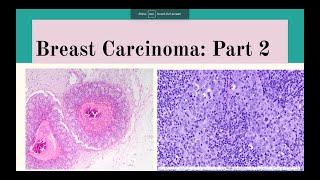 Breast Carcinoma Part 2 [upl. by Yoj432]