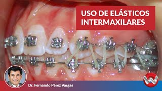 Uso de Elásticos Intermaxilares [upl. by Daj]