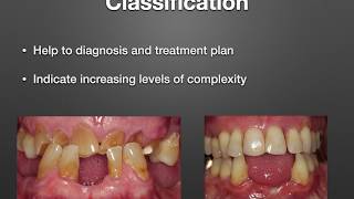 POST amp CORE  ENDODONTICS amp PROSTHODONTICS  5 minute Dentistry [upl. by Ahsi]