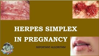 Herpes Simplex in Pregnancy Important Algorithm from BAASH Guidelines [upl. by Dloniger]