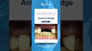 K Family Dentistry Anterior Bridge tooth 6  11 case study reels dentalcare dentalprocedure [upl. by Adehsar]