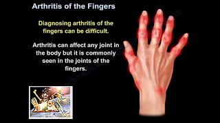 Arthritis Of The Fingers  Everything You Need To Know  Dr Nabil Ebraheim [upl. by Deloria]